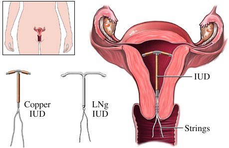 IUD (Intrauterine Device) – ParaGard (Copper IUD) or Mirena (Hormonal IUD) 