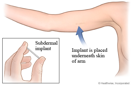 Implant – Implanon or Nexplanon