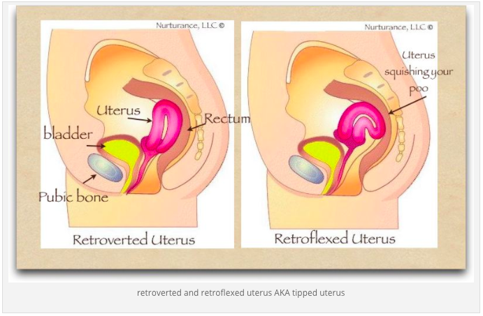 Retroverted and Retroflexed uterus