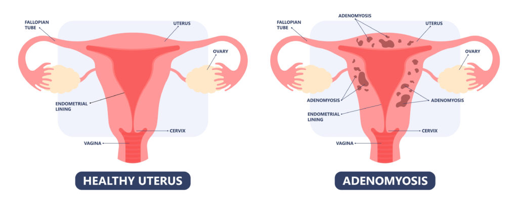 What is Adenomyosis & How is it Treated - Nicole Jardim